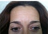 Antes da aplicação de Botox