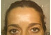 Depois da aplicação de Botox