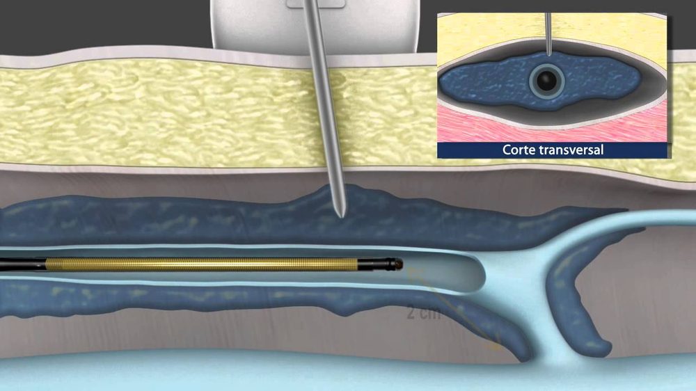 Vídeo: tratamento de varizes por radiofrequência — Cirurgia Vascular na Clínica MECE